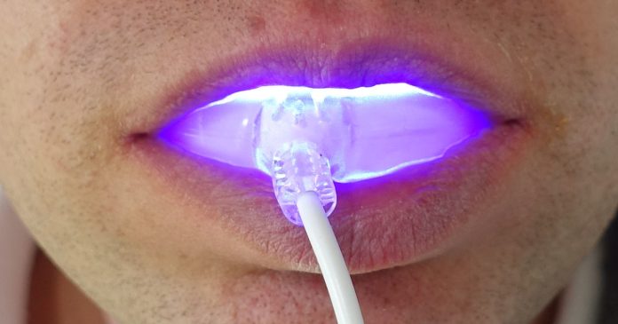 at-home-teeth-whitening